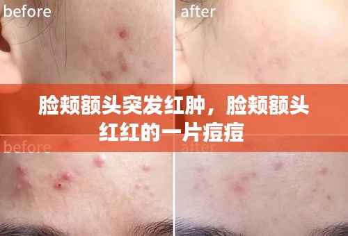 脸颊额头突发红肿,脸颊额头红红的一片痘痘